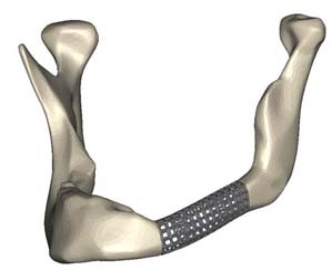 Mandible reconstruction with a cage design