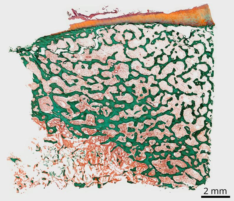 Bone structure modified by cancer cells by Aurélie Levillain
