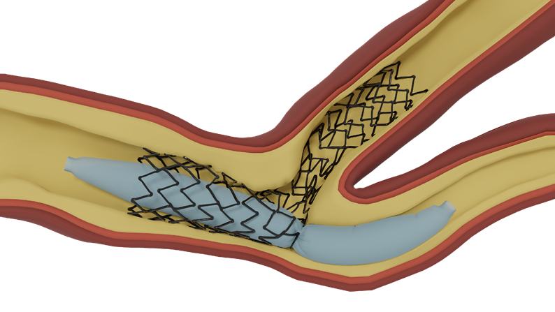 Simulation of coronary stent deployment in a bifurcated artery by Luca Antonini